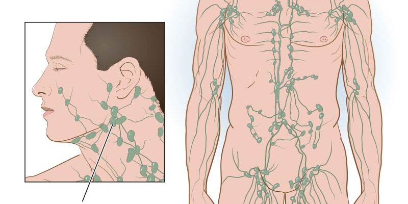 15219-swollen-lymph-nodes