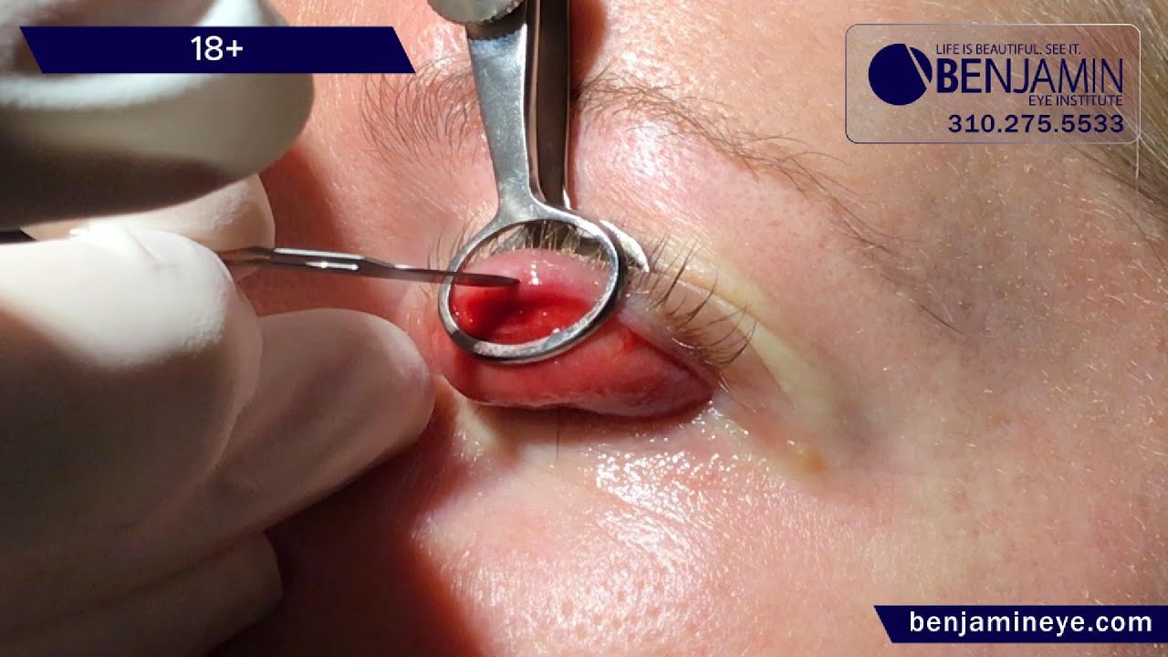 What happens if u pop a stye: example and key details