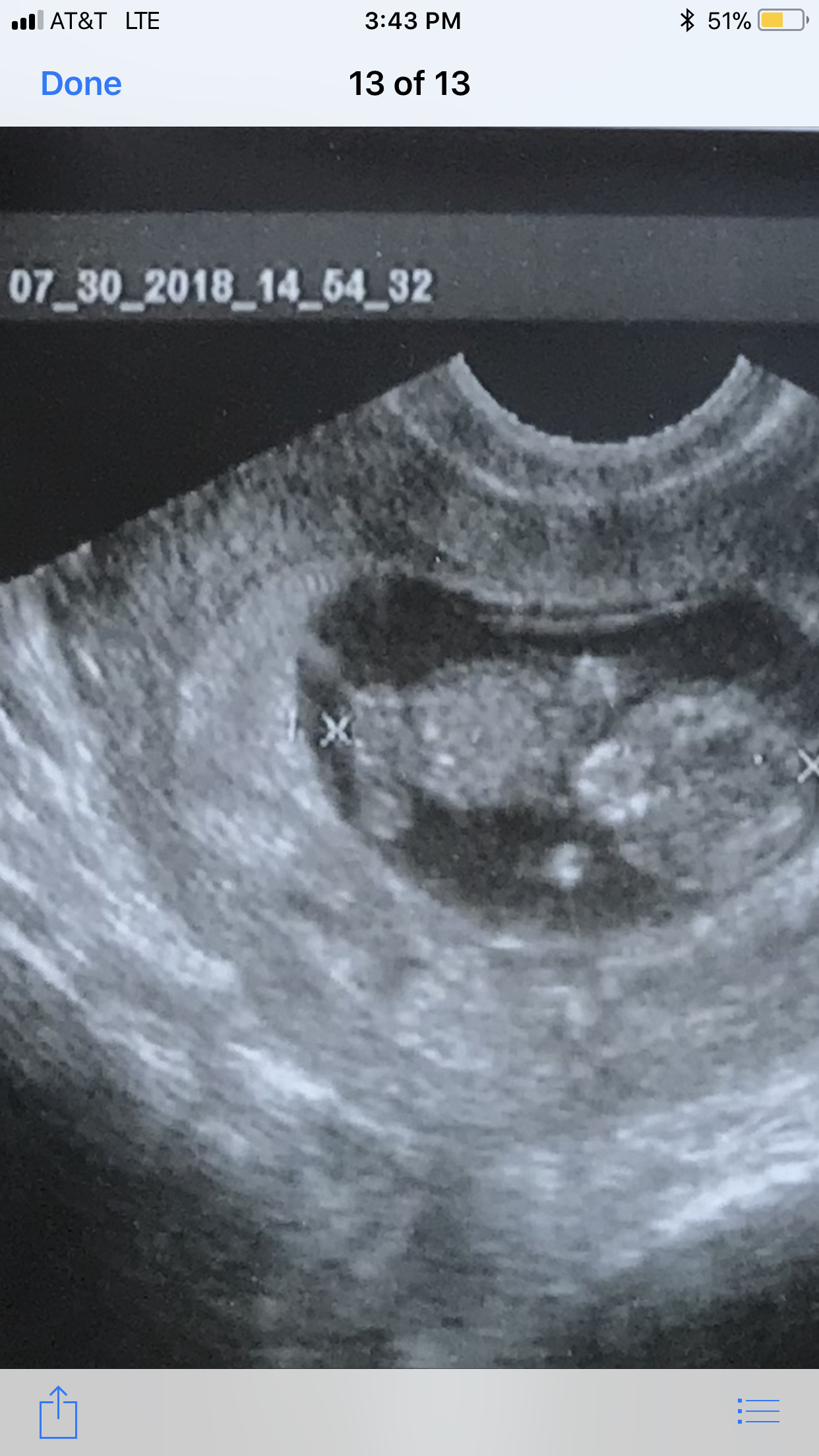 Is it normal to not feel pregnant at 15 weeks: main illustration