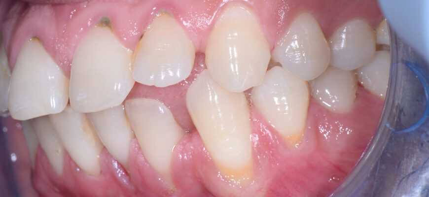 64dc716293c588f5e2e54cbd_Periodontal-Disease