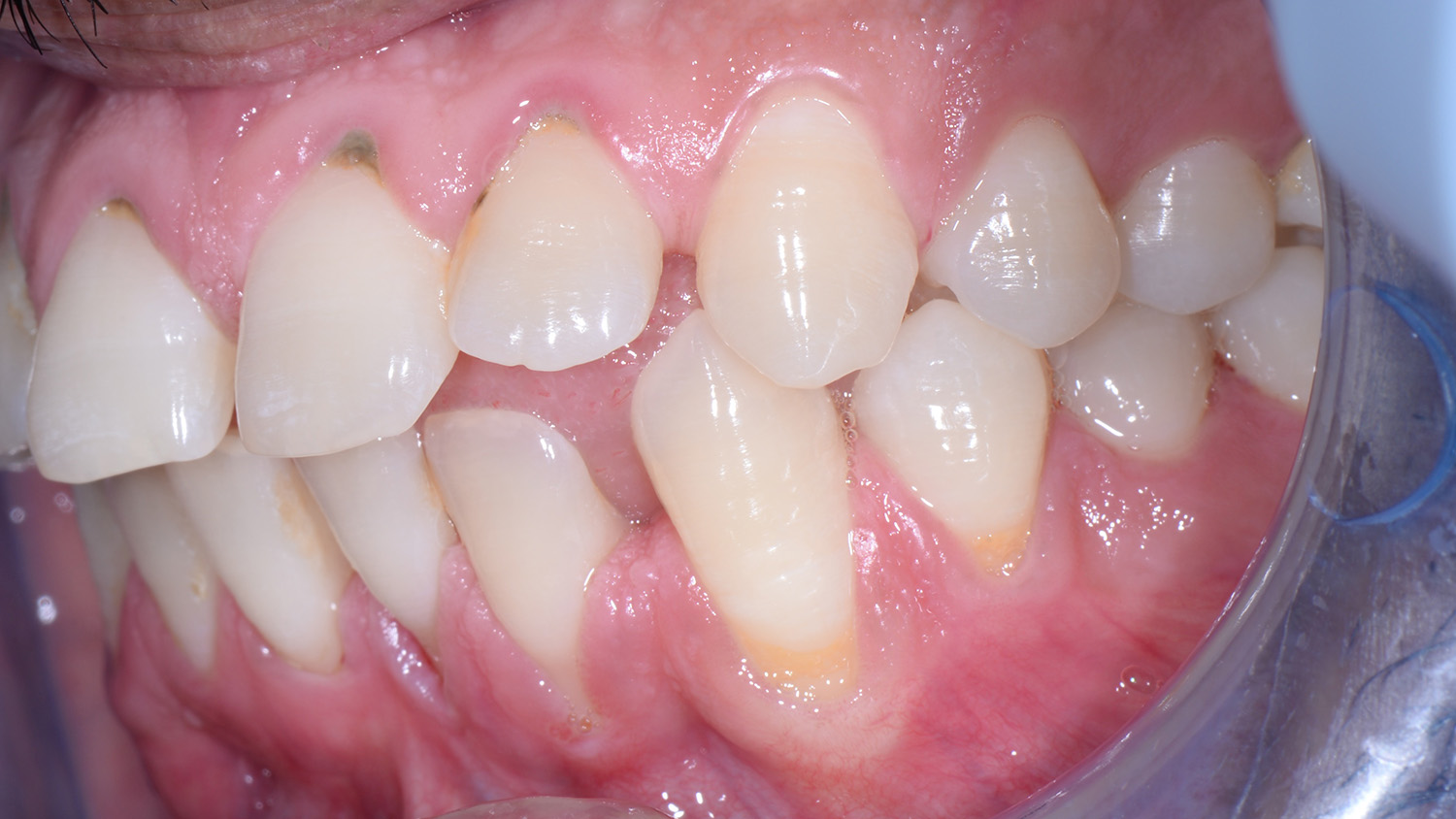 Why do my tooth feel loose: main illustration