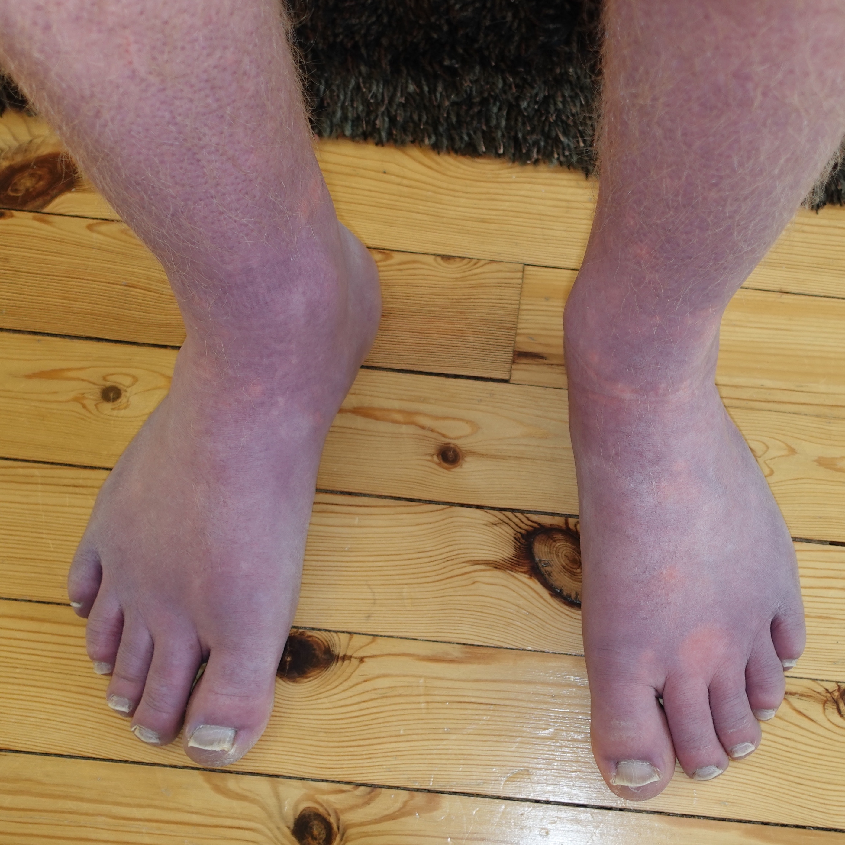 Why does my feet look purple: visual explanation