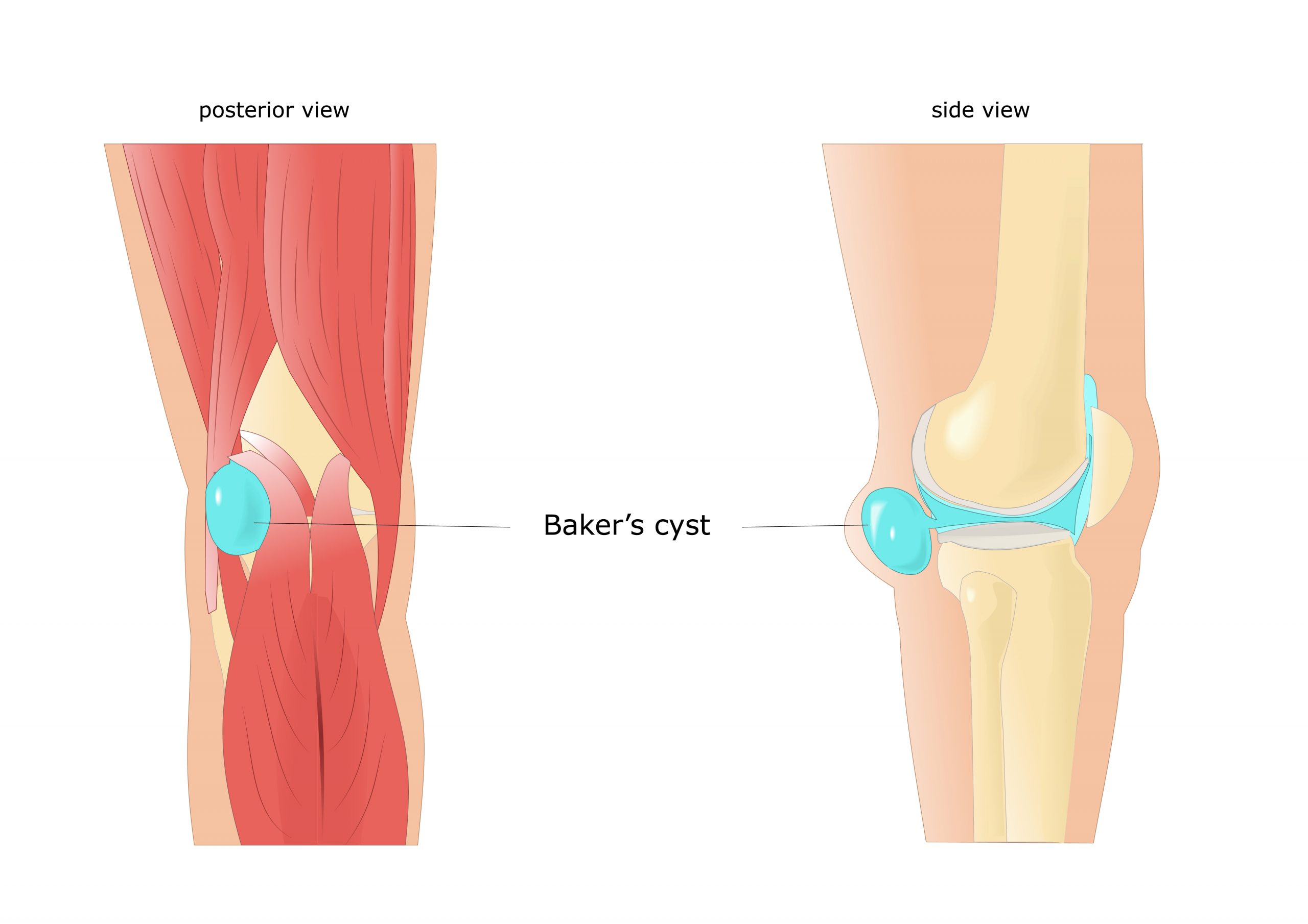 What causes runner knee: visual explanation