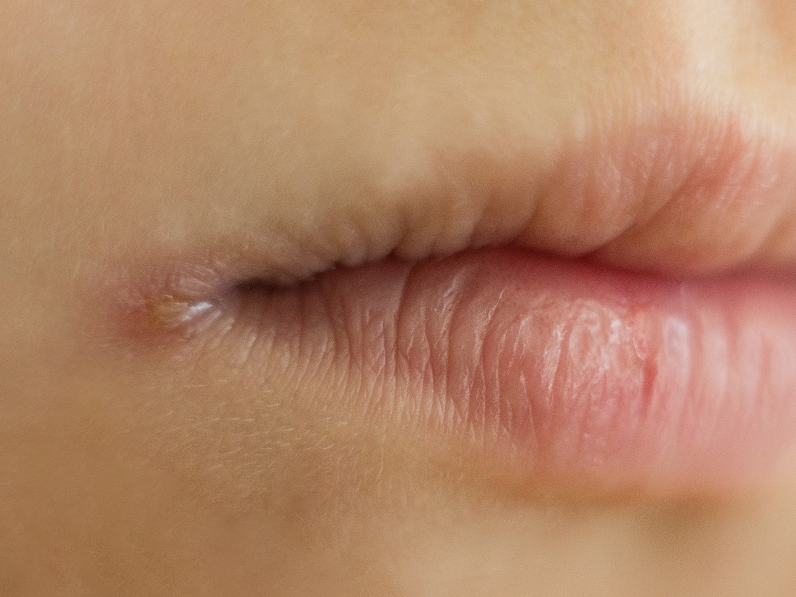 What causes corners of mouth to crack: main illustration