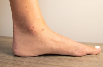 Ant_bites