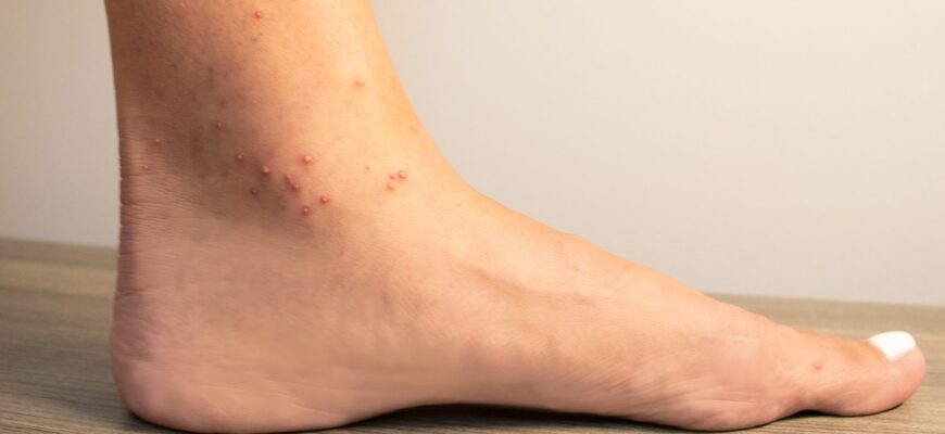 Ant_bites