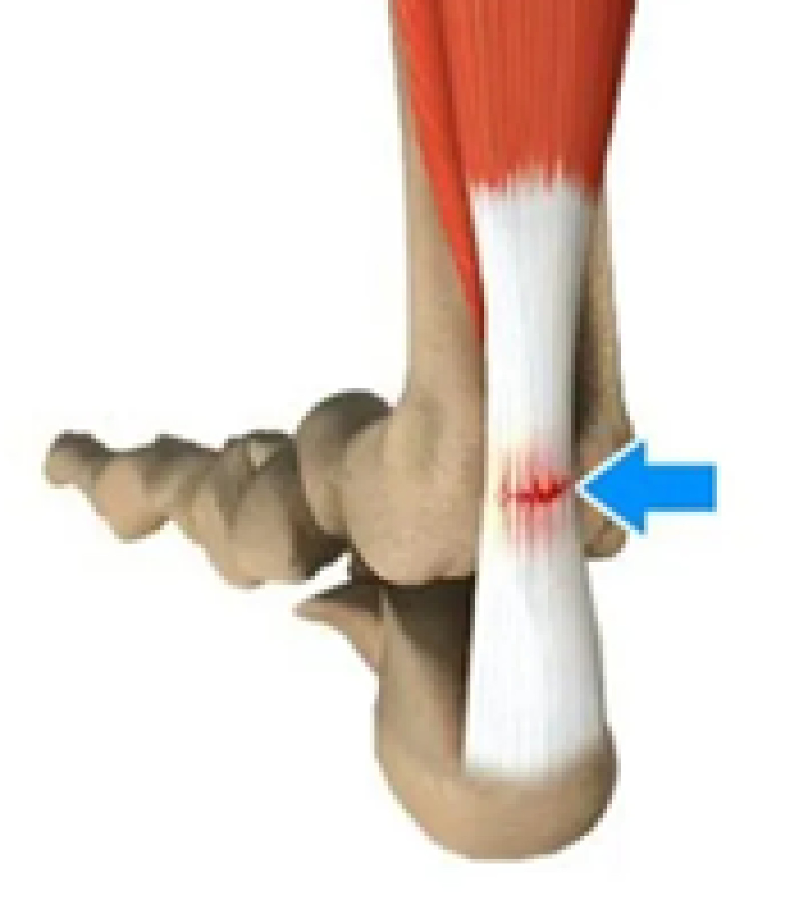 What causes achilles rupture: example and key details