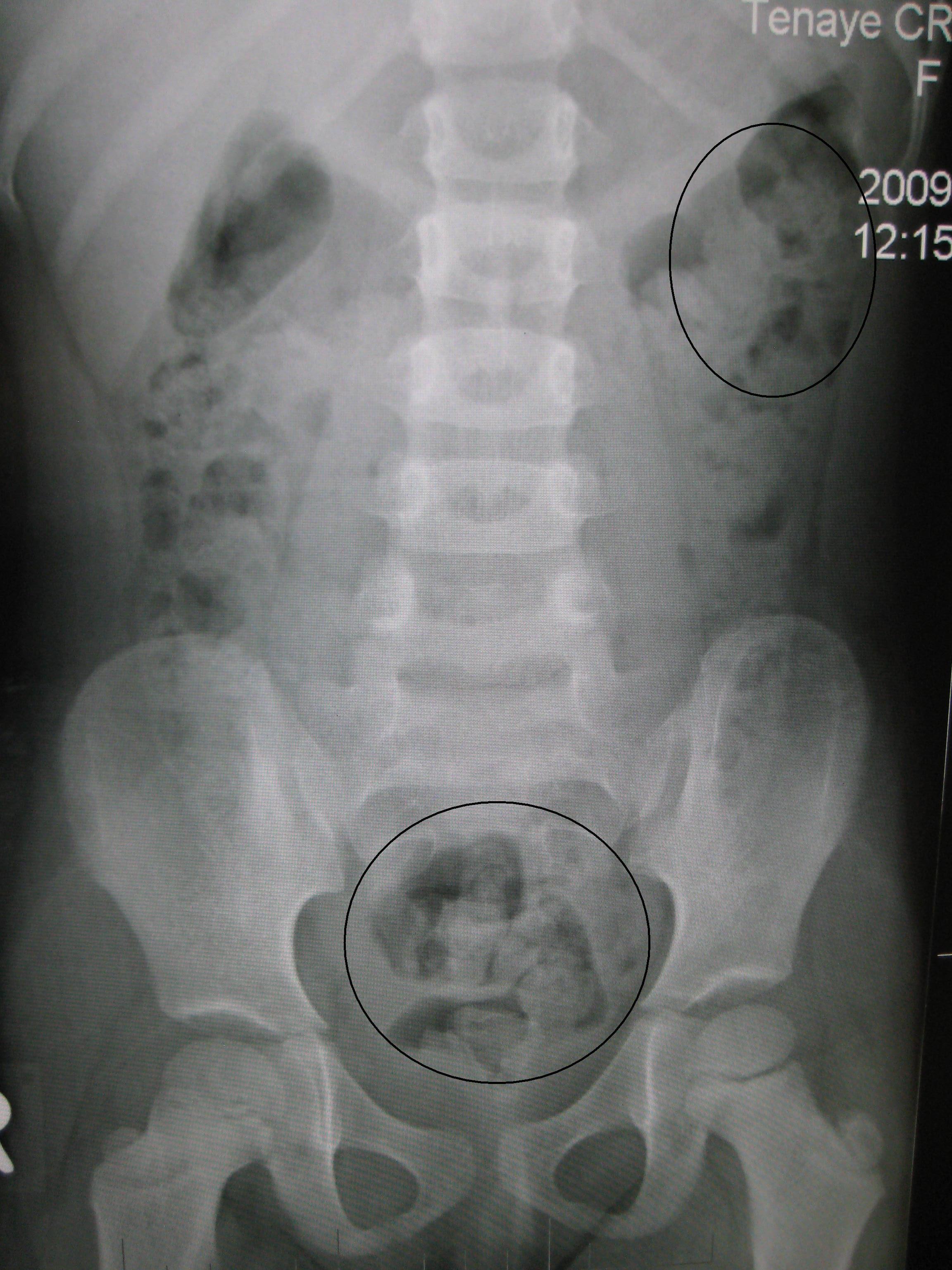 Why does constipation occur: visual explanation