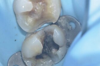 Deep-crack-case-example-Dr.-Davey-Alleman-DMD-2