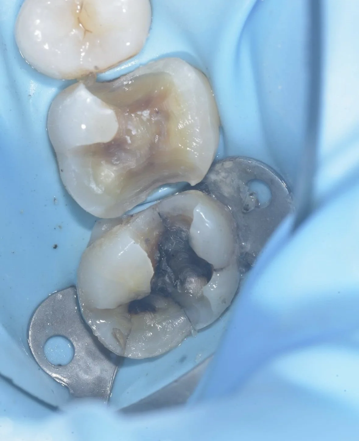 What causes crack in teeth: main illustration