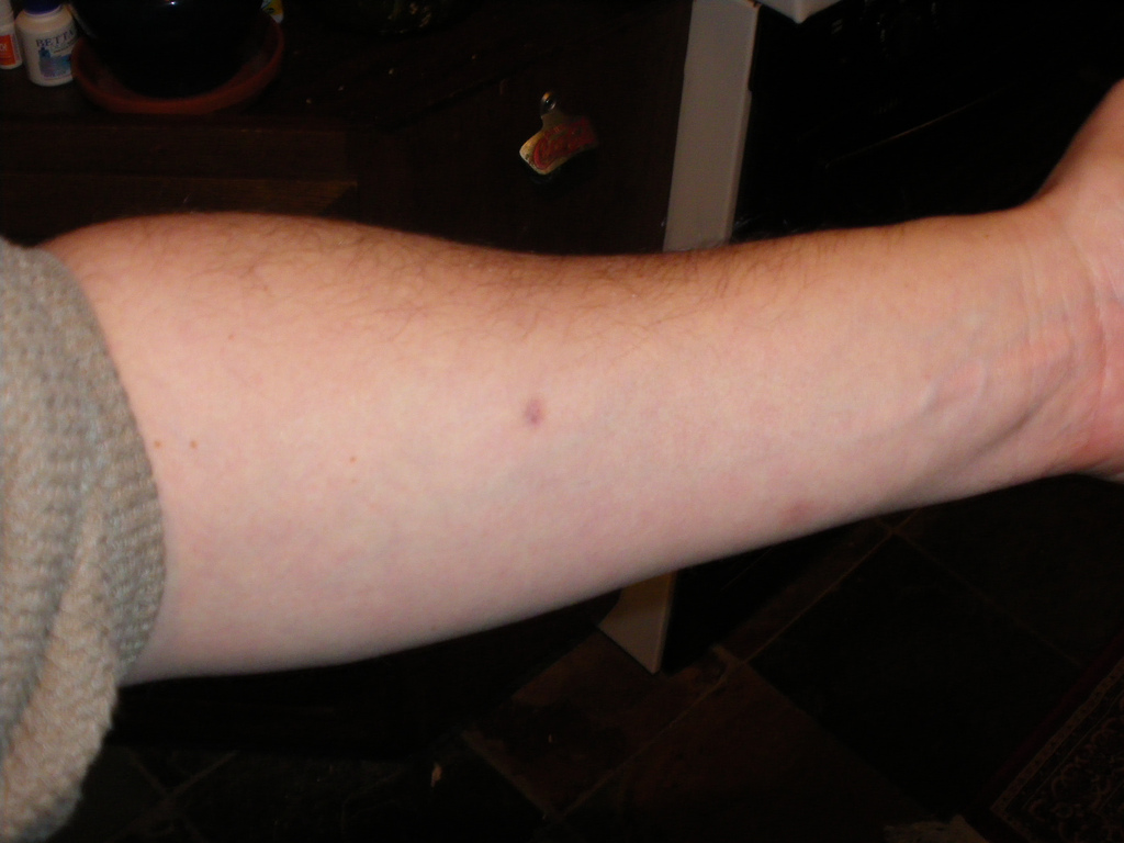 How does tb skin test positive look: visual explanation