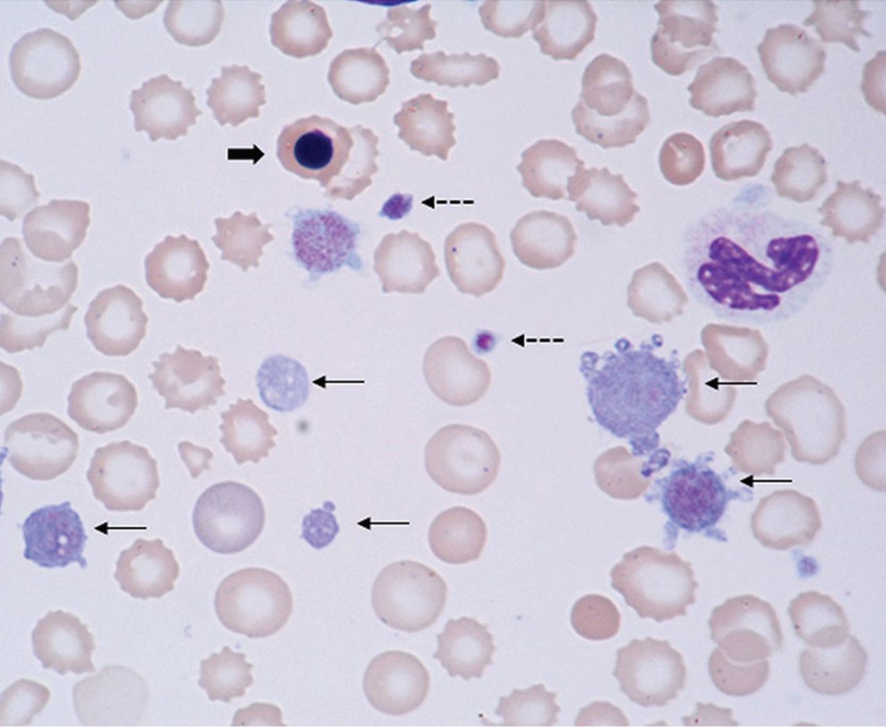 What causes red cell distribution width to be high: example and key details
