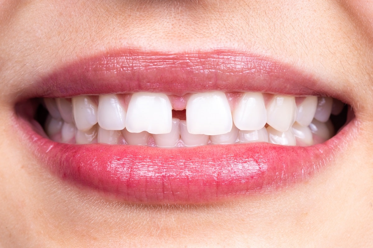 What causes a gap in teeth: example and key details
