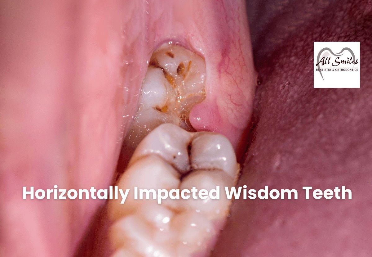 Why does wisdom teeth grow sideways: main illustration