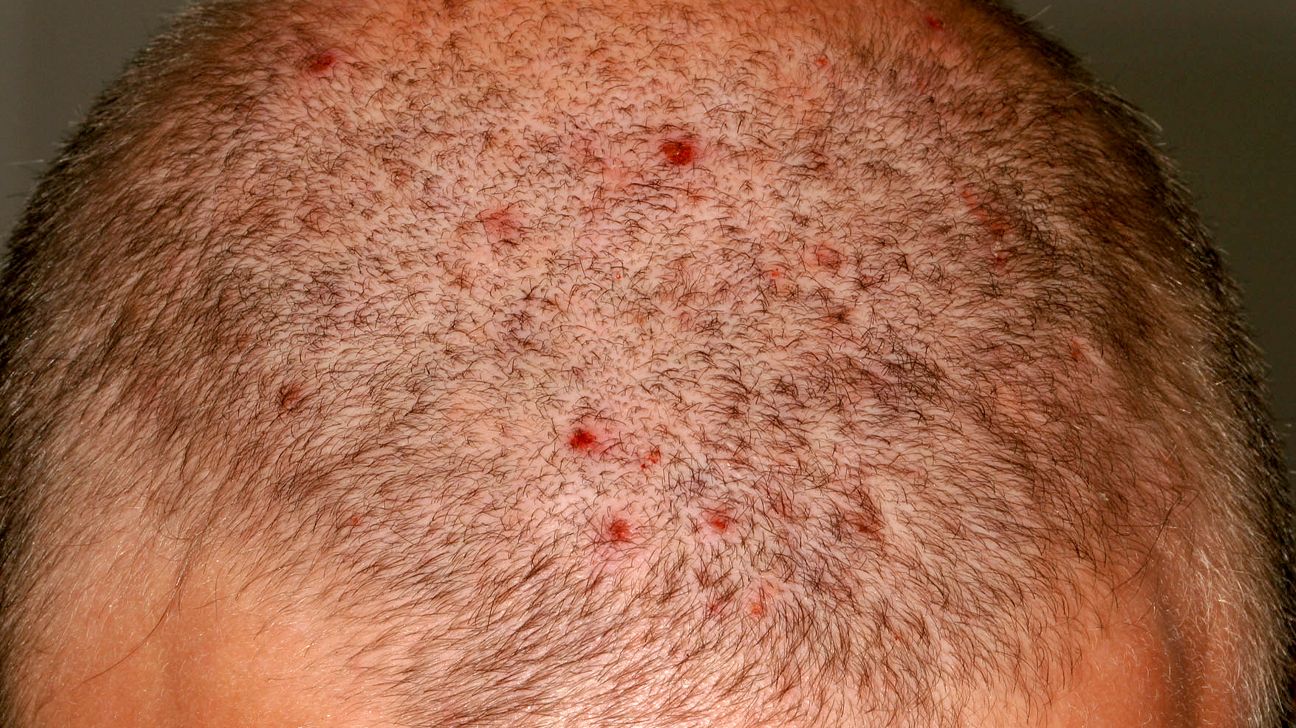 What causes inflammation of the scalp: example and key details