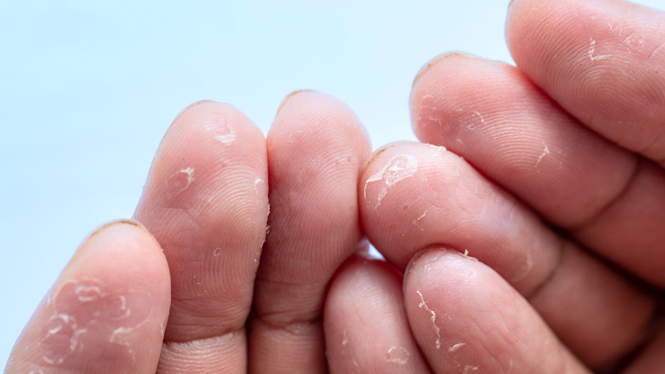 Why does the skin on my fingers peel: visual explanation