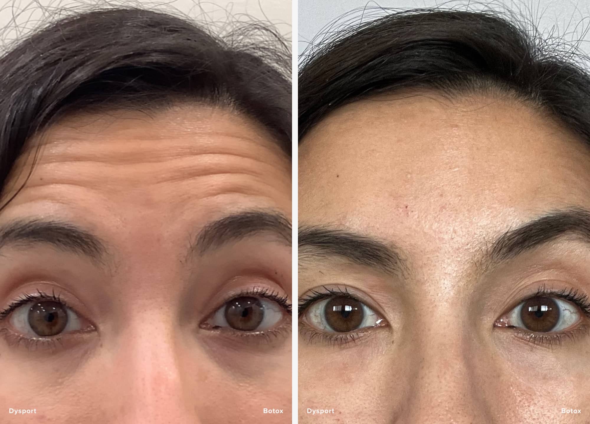 Which is better botox or dysport: main illustration
