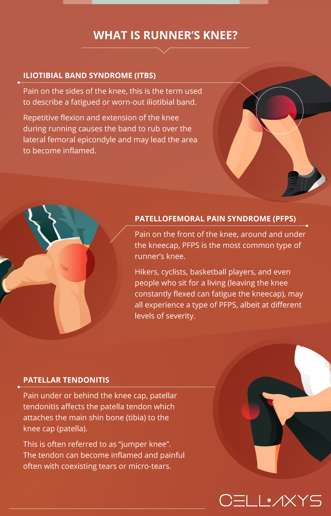 What causes runner knee: main illustration