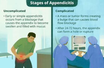 VWH-MiraNorian-StagesofAppendicitis-Standard-076ef0b303224311a97bf2e6312c4acf