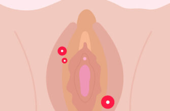 Vaginal-pimples-1