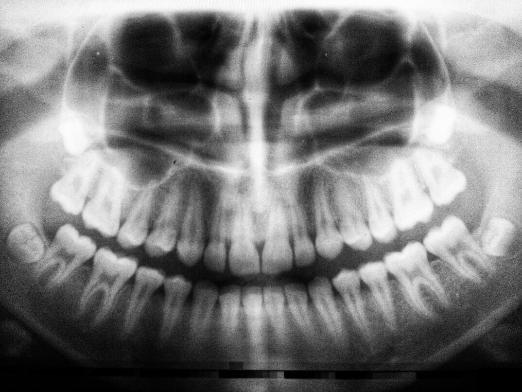 What causes crack in teeth: visual explanation