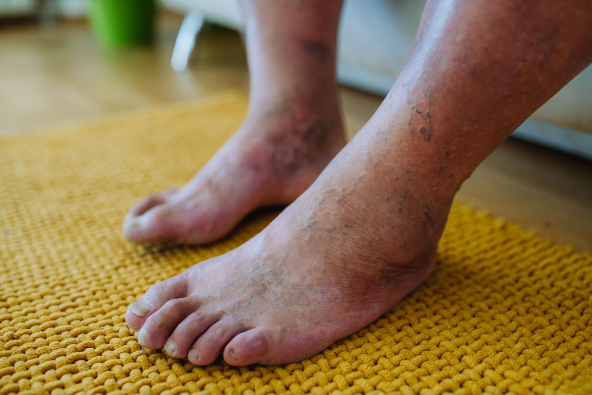 Why does my feet look purple: main illustration