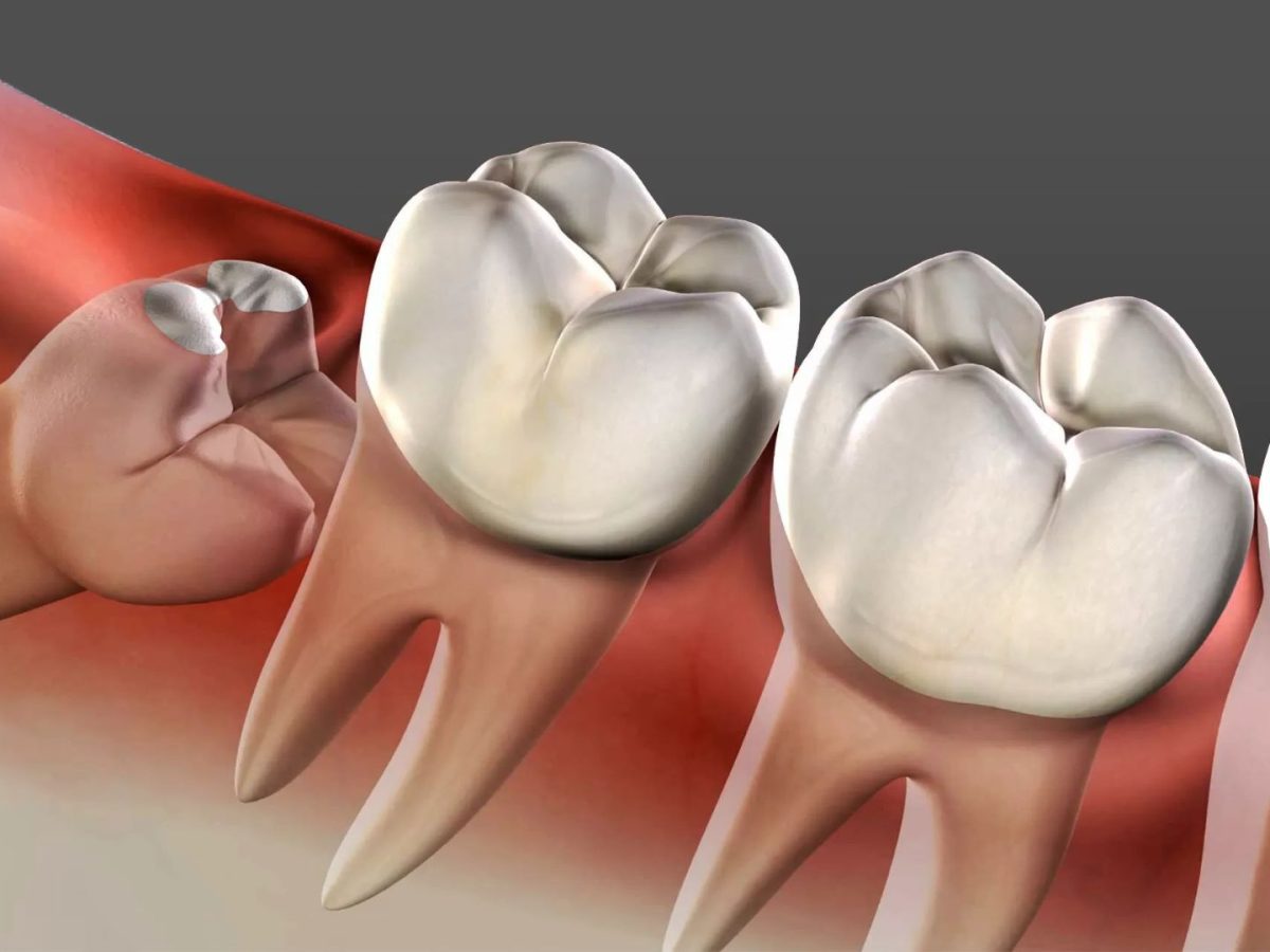 Why does wisdom teeth pain come and go: visual explanation