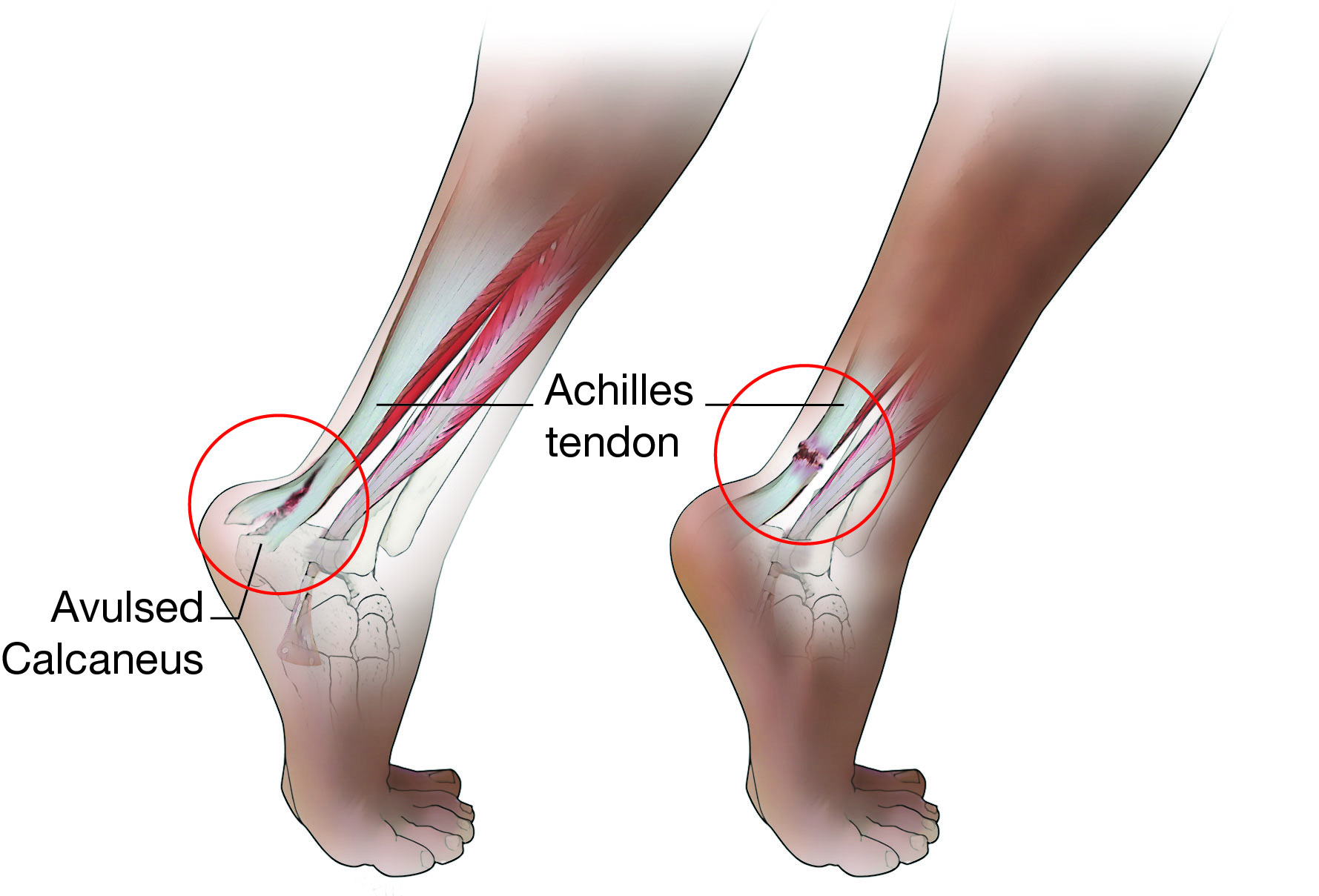 What causes achilles rupture: main illustration