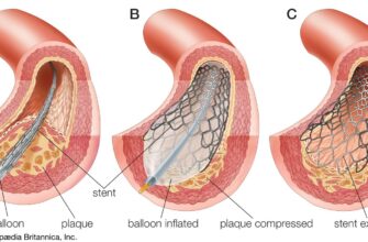 artery-balloon-plaque-catheter-stent-Balloon-angioplasty