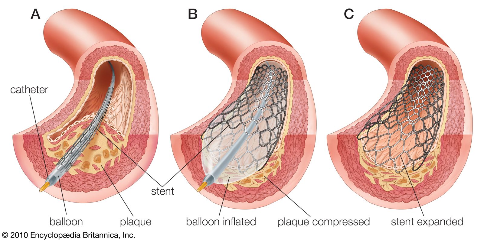 What causes plaque on the heart: main illustration