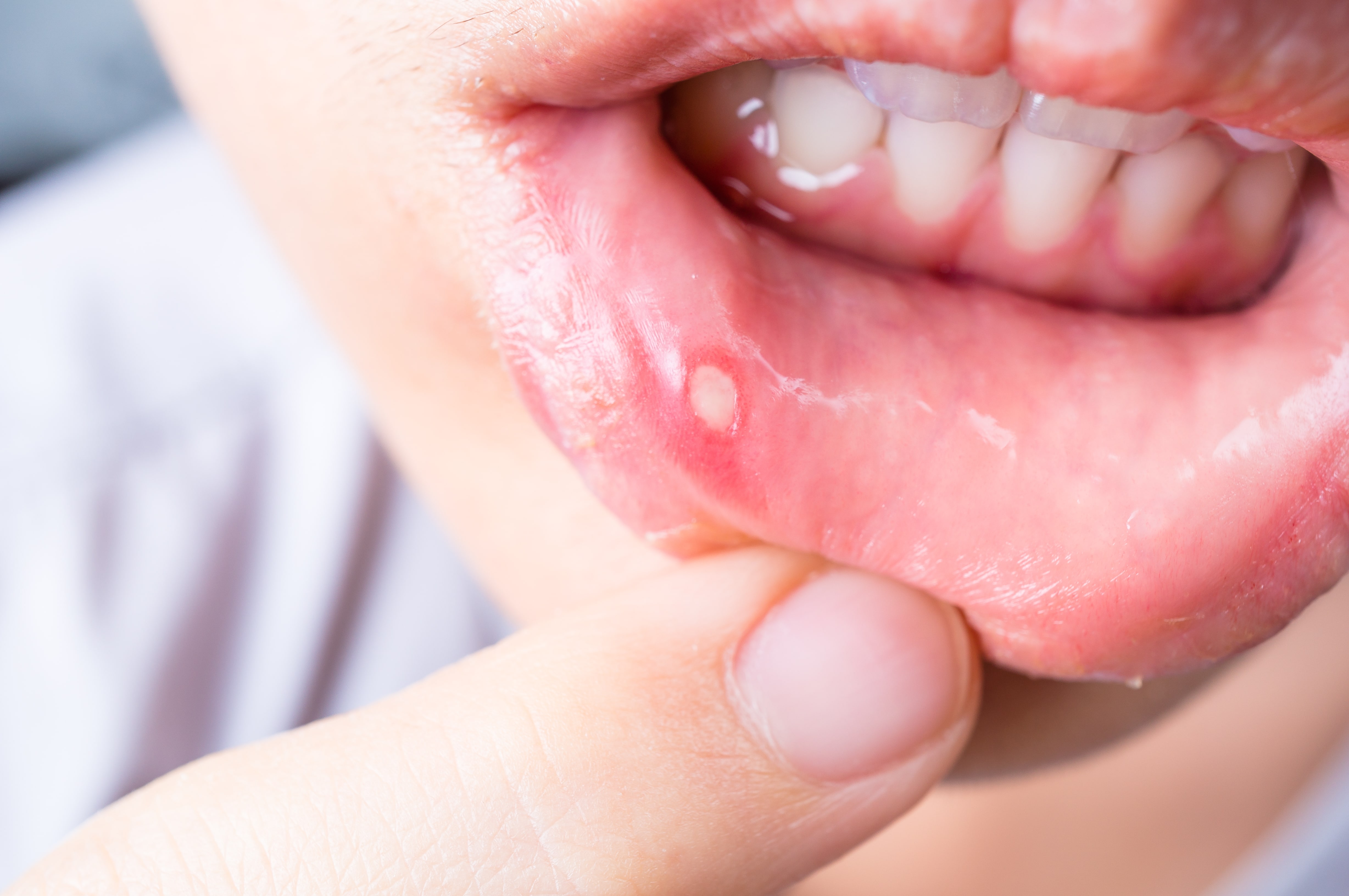 Why do i keep getting canker sores in my mouth: visual explanation