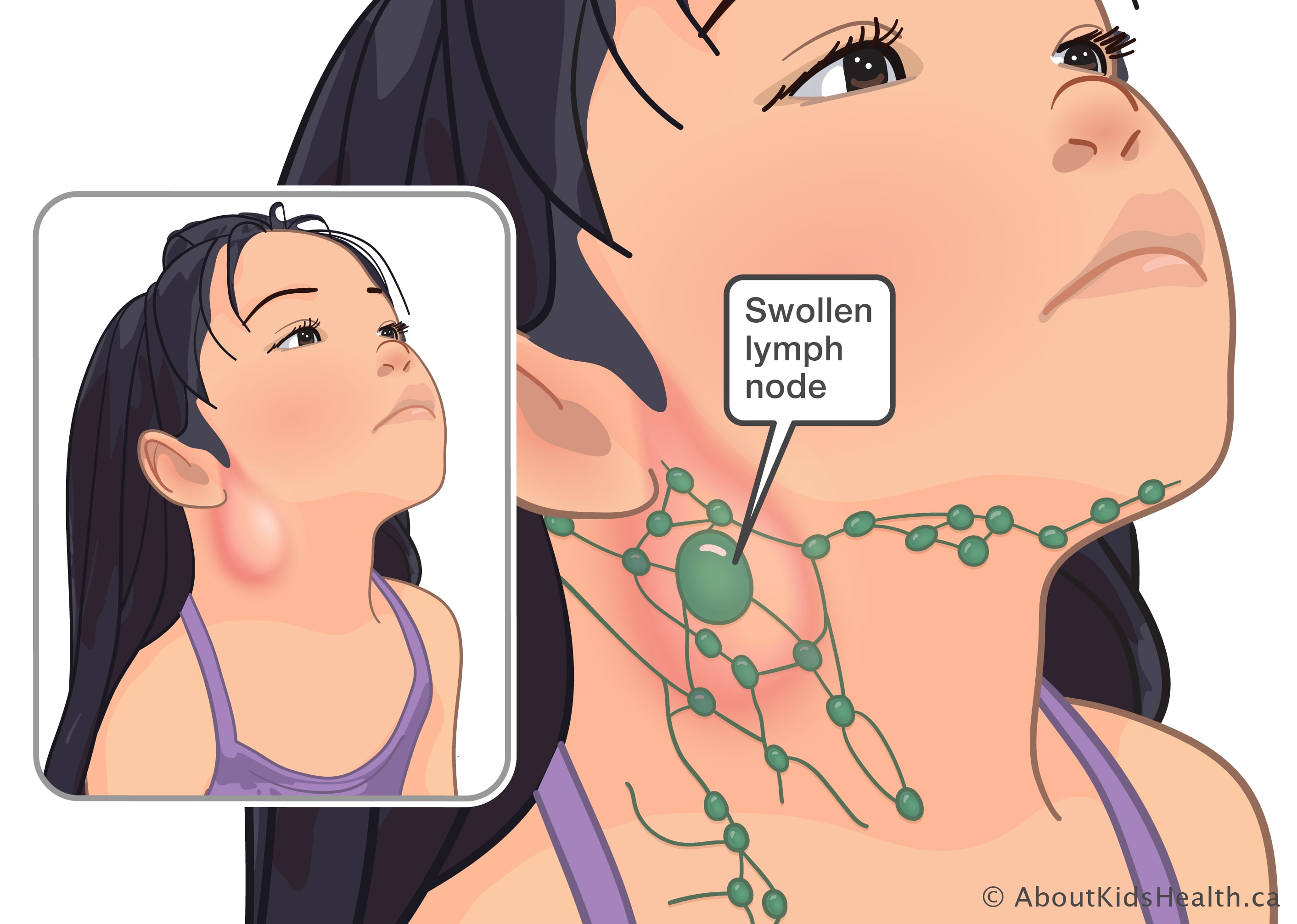 What causes your lymph nodes to be swollen: example and key details