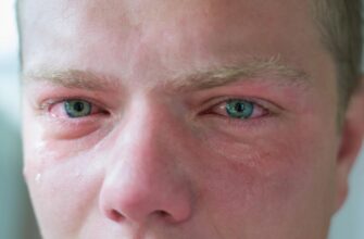 crying-swollen-red-eyes-979912362