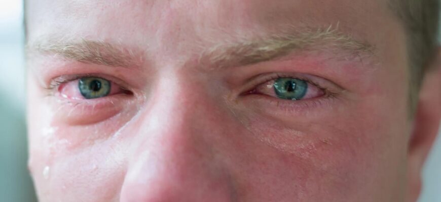 crying-swollen-red-eyes-979912362