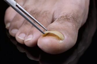 detached-toenail