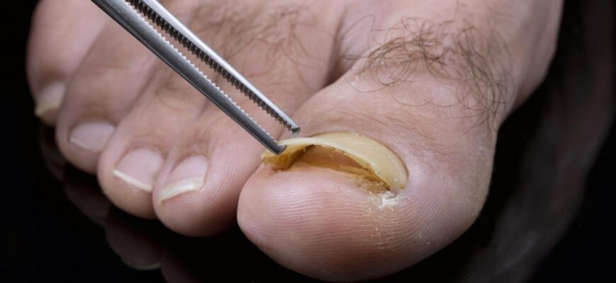 detached-toenail