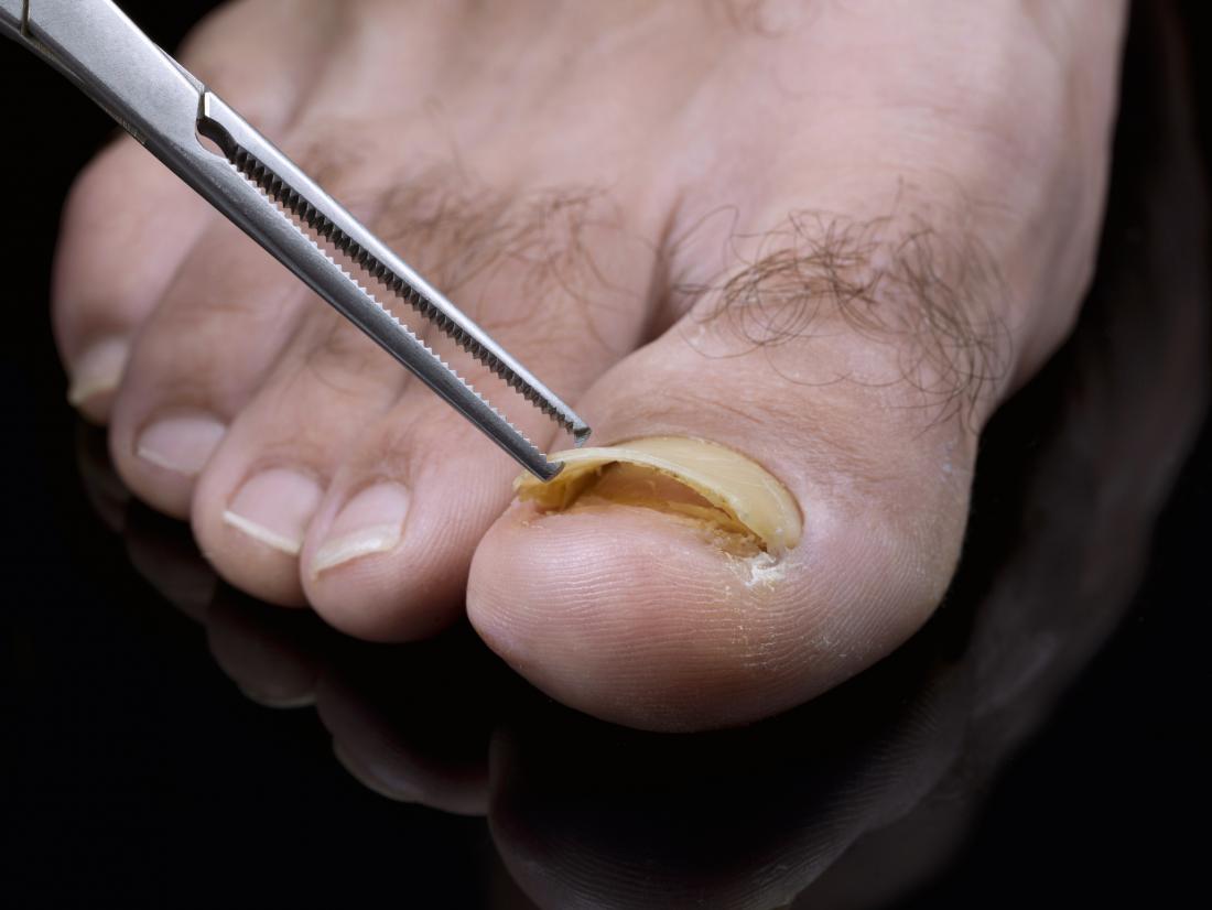 What to do if nail falls off: main illustration