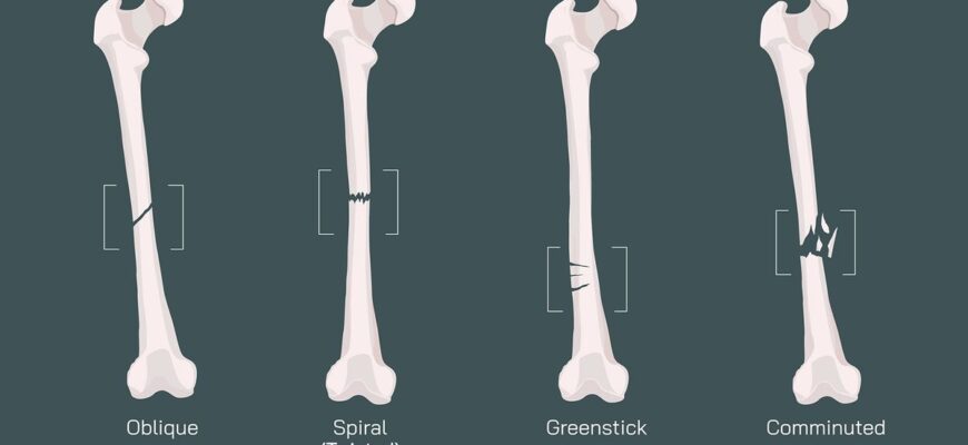 Types,Of,Bone,Fracture.,Structure,Of,A,Bone,Vector,Illustration.