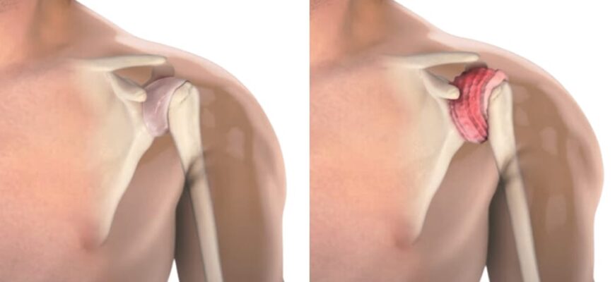 frozen-shoulder