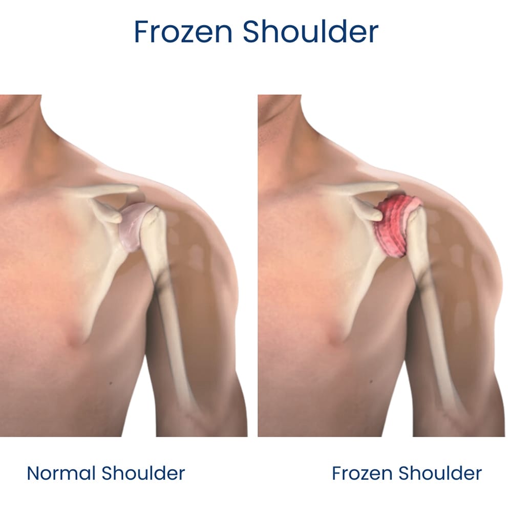 Why does my shoulder hurt when i lift my arm: main illustration