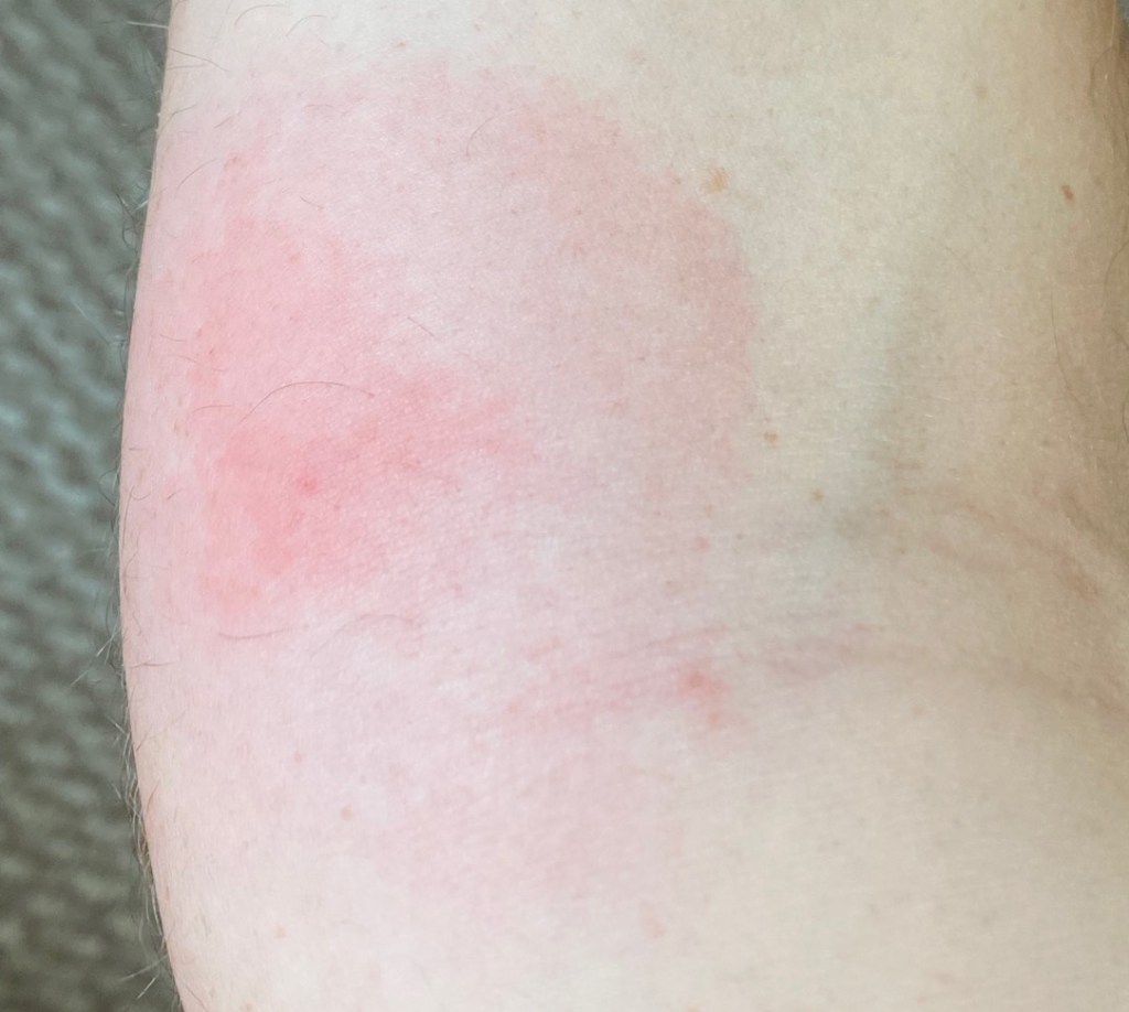 Can normal ants bite: visual explanation