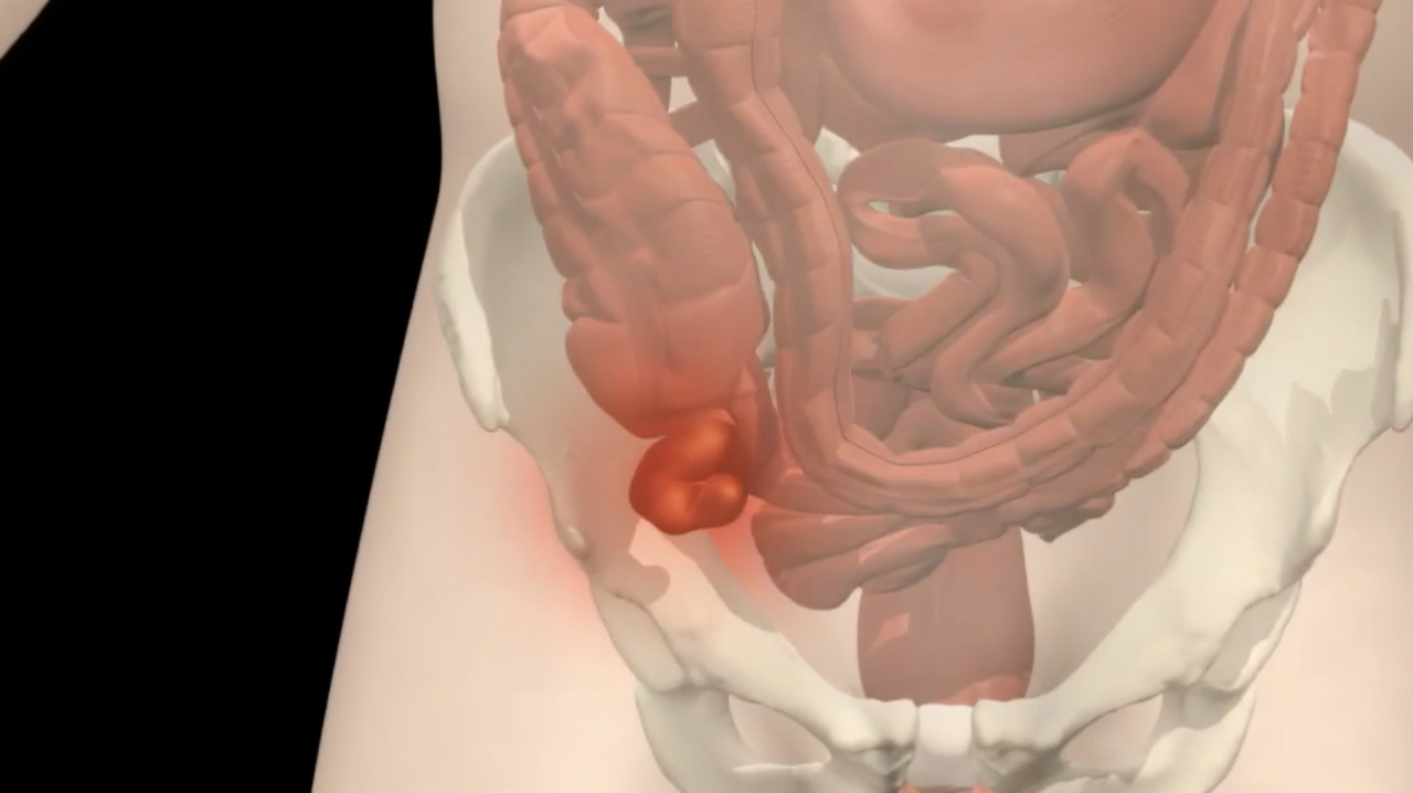 What can happen if your appendix burst: visual explanation