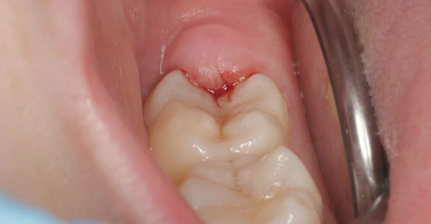 Why do my back gums hurt: visual explanation
