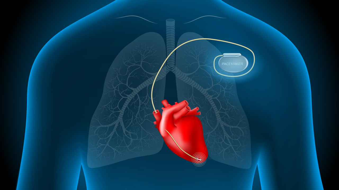 Why do people need a pacemaker: main illustration
