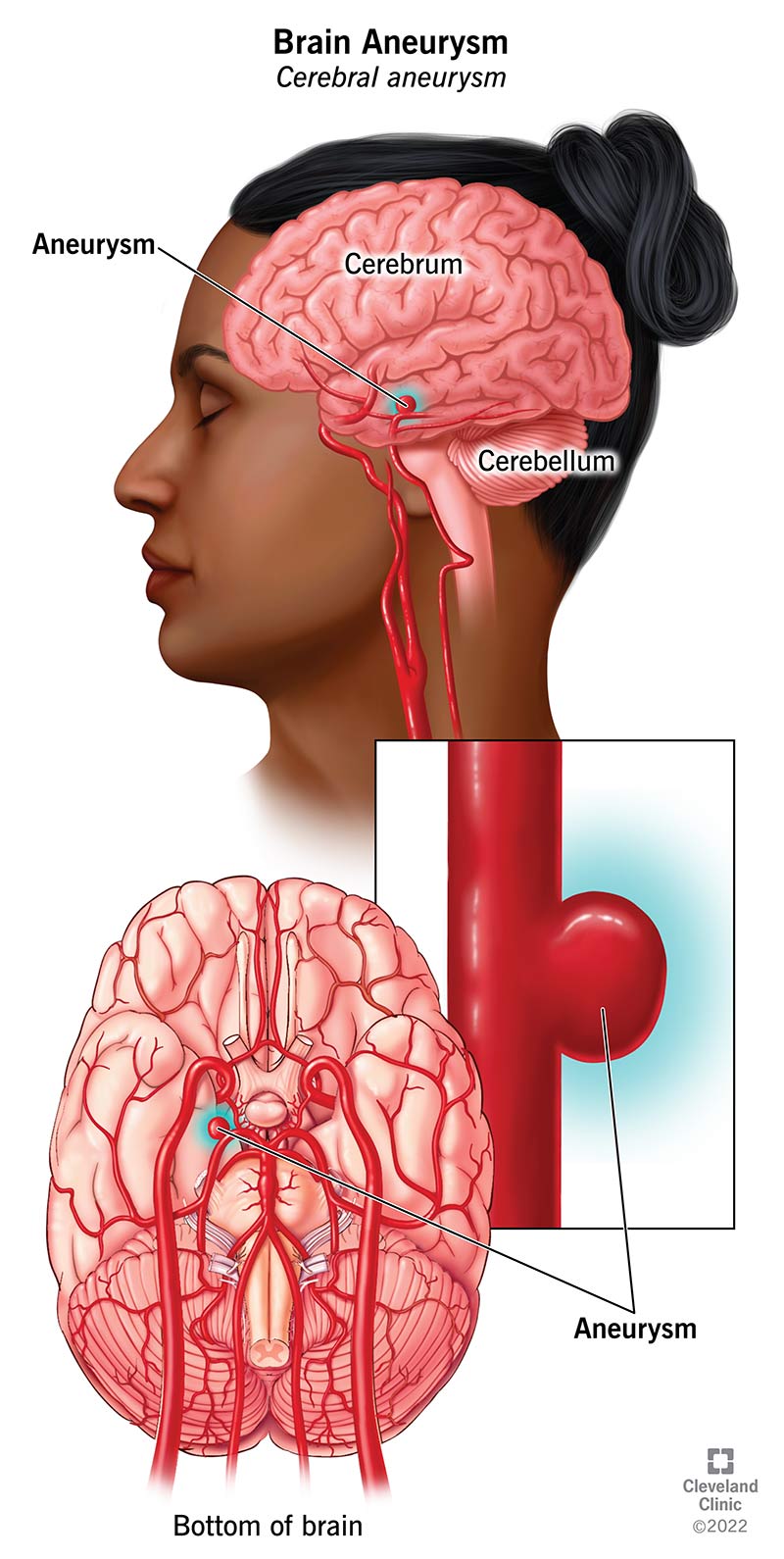 Why does my brain ache: example and key details