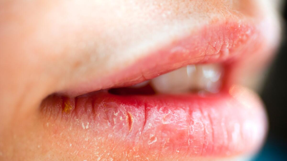 What does it mean when your lips are dry: visual explanation