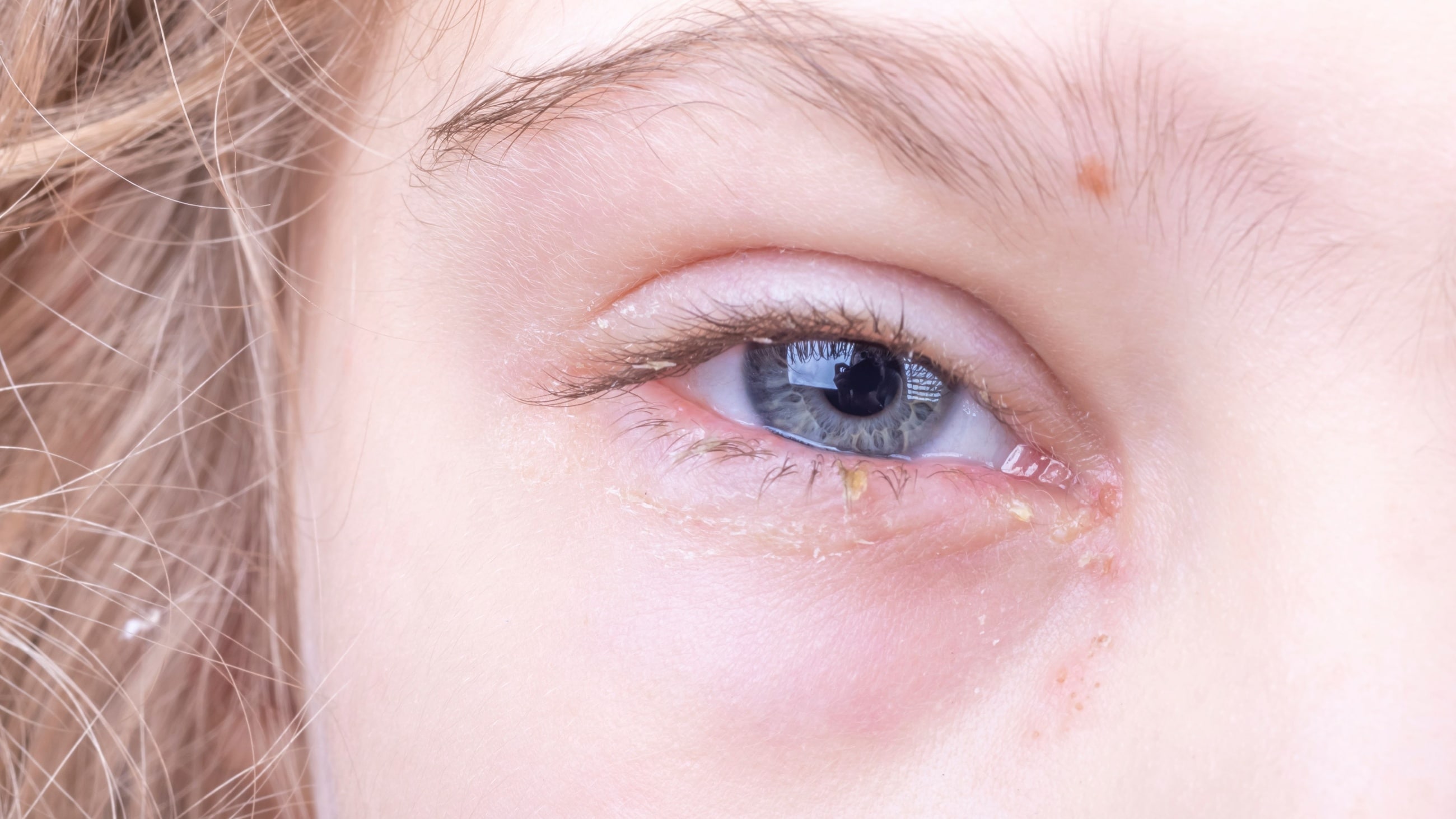 Why do u get eye boogers: main illustration