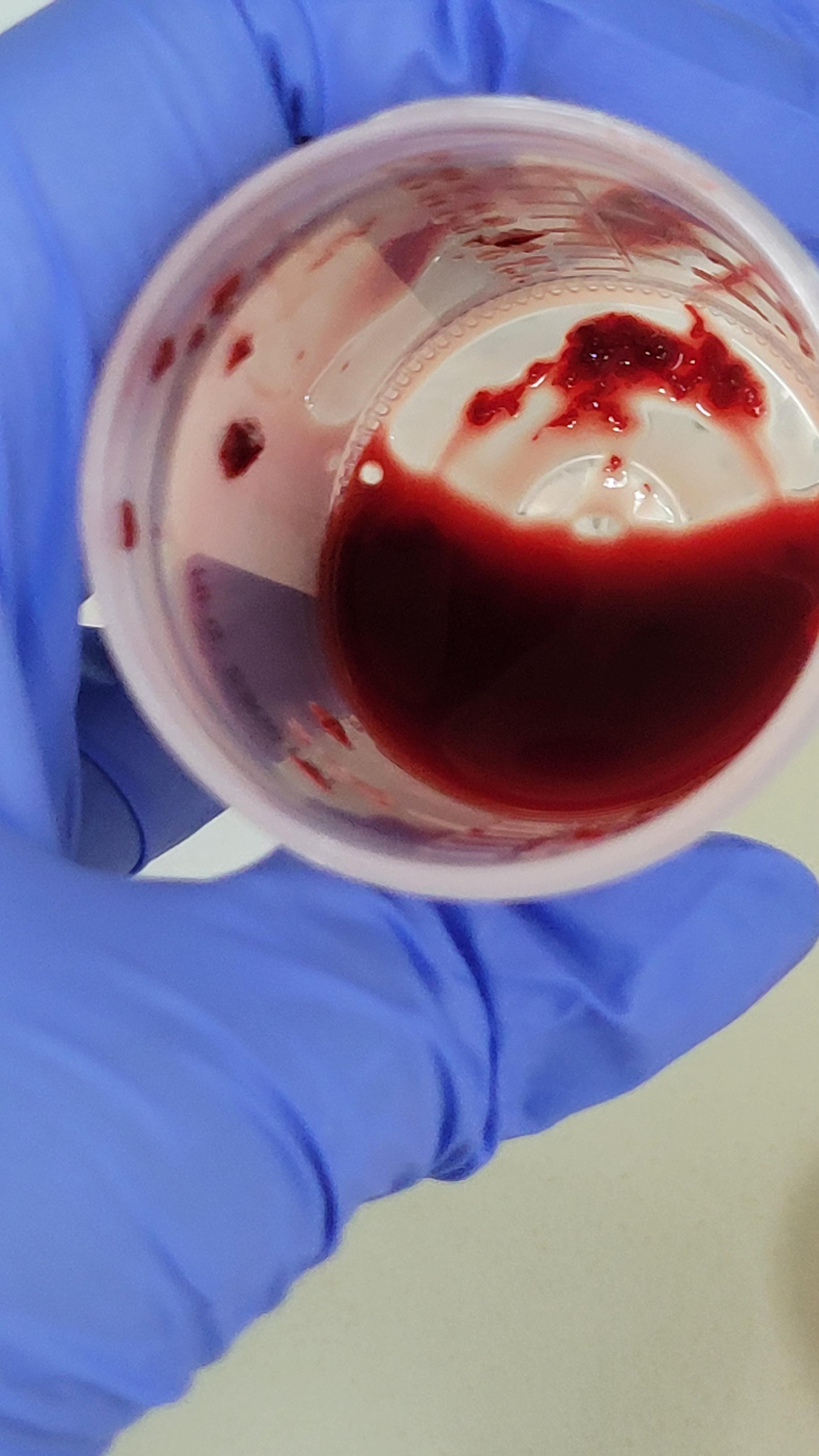Why do guys pee blood: example and key details