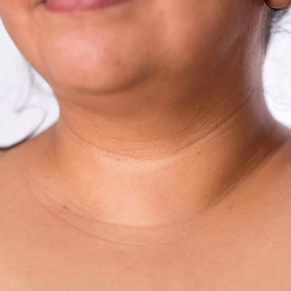 Why does my neck have lines: example and key details