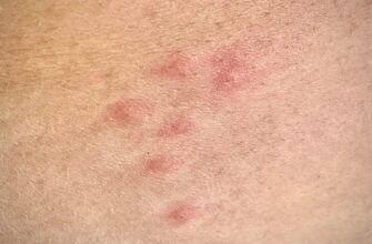 sandfly-bites-royalty-free-image-1745336704pjpeg